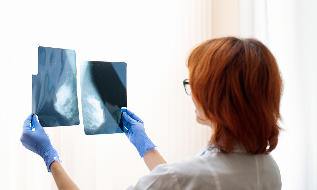 Nódulo na mama: quando devo me preocupar?