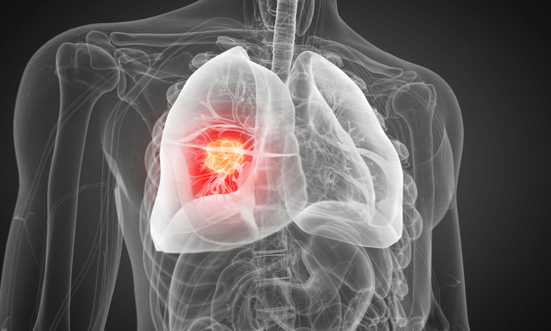 Câncer de pulmão: tipos, sintomas e tratamentos