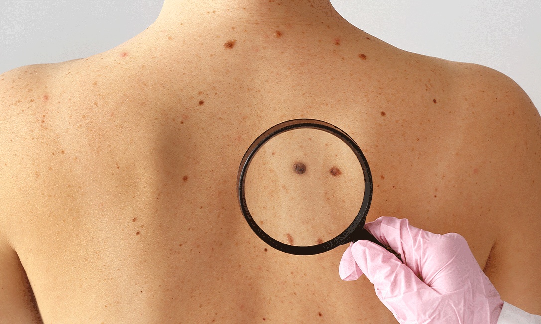 Saiba o que é melanoma, o câncer de pele mais agressivo - Vence Onco