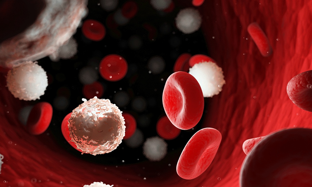 Câncer no sangue: saiba mais sobre leucemia, mieloma e linfoma