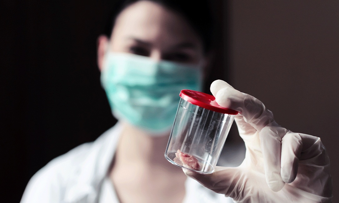 A importância da biópsia no diagnóstico de câncer