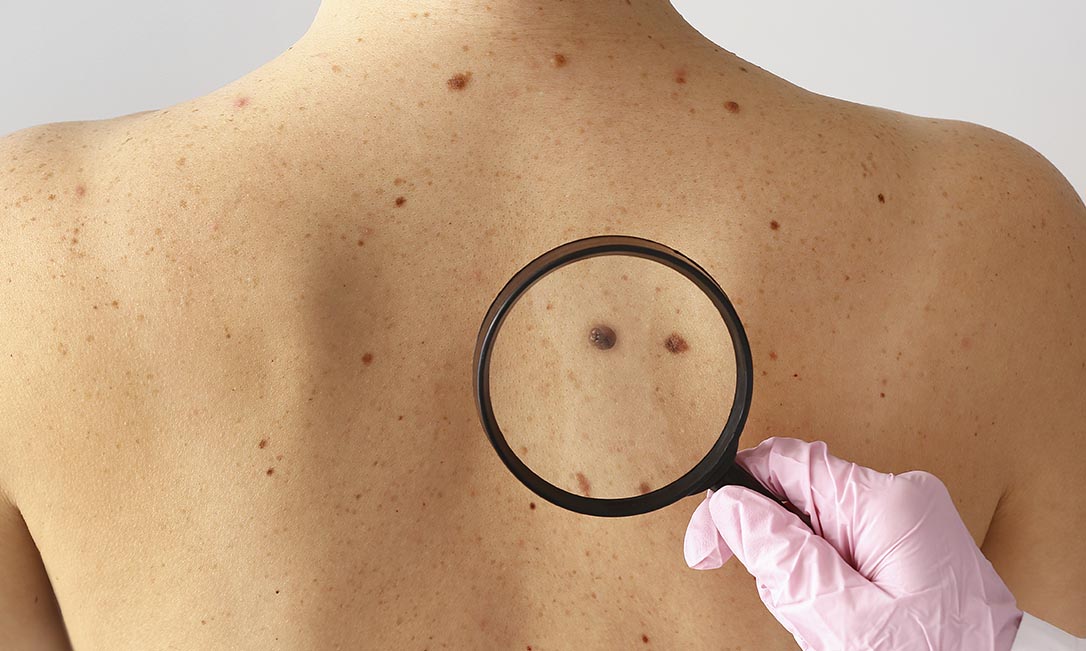 Melanoma maligno: do diagnóstico ao tratamento