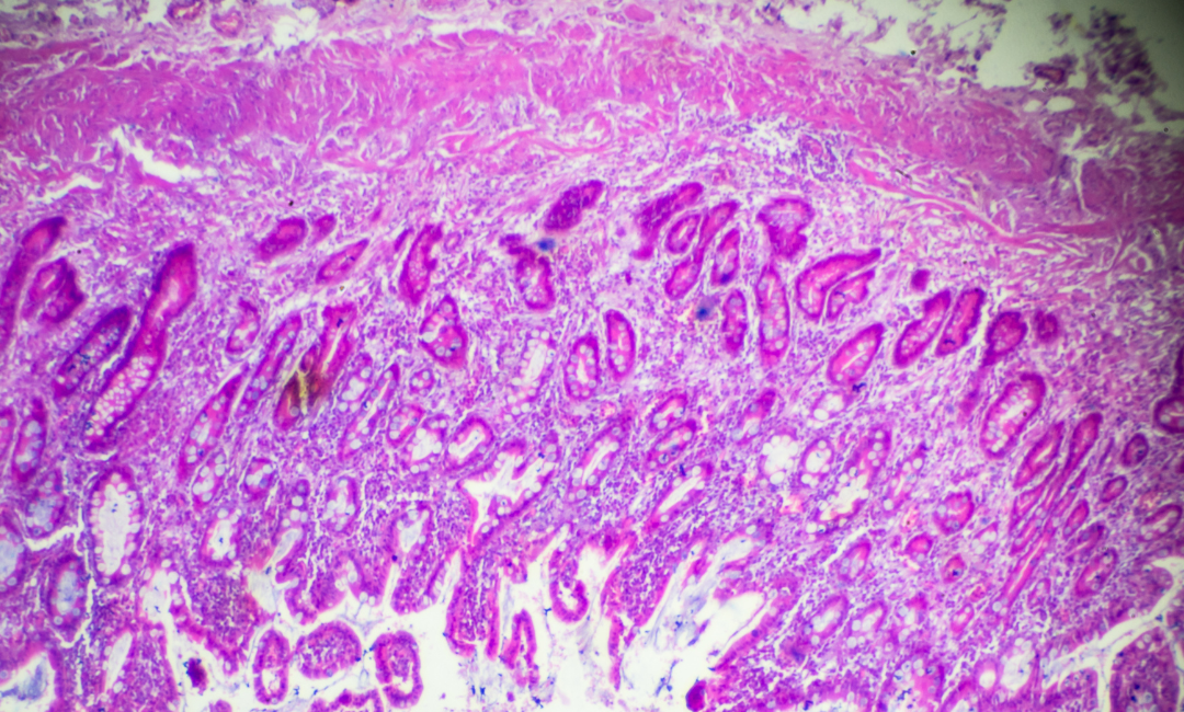 O que é adenocarcinoma?