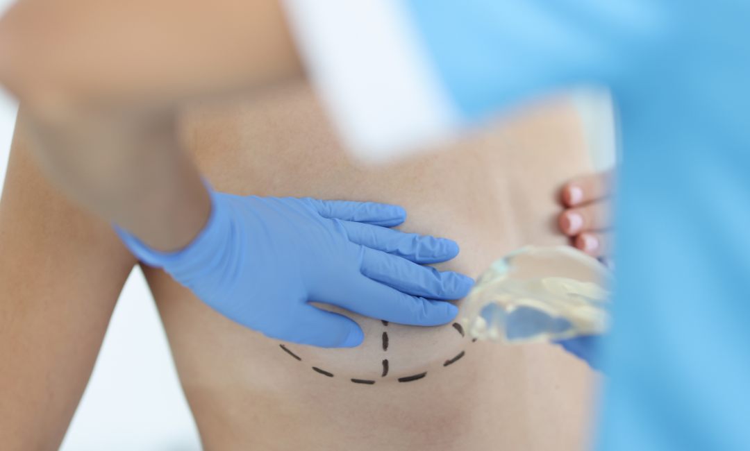 O que é reconstrução mamária?