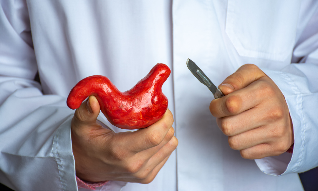 Bariátrica e câncer de estômago: entenda a relação