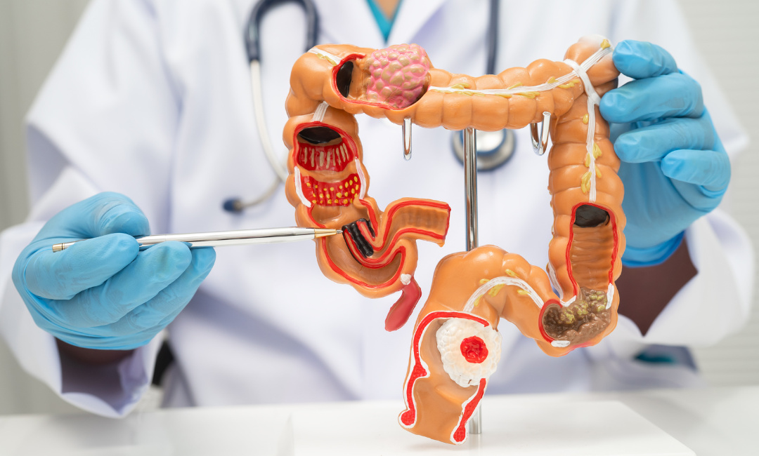 7 hábitos para prevenir o câncer colorretal