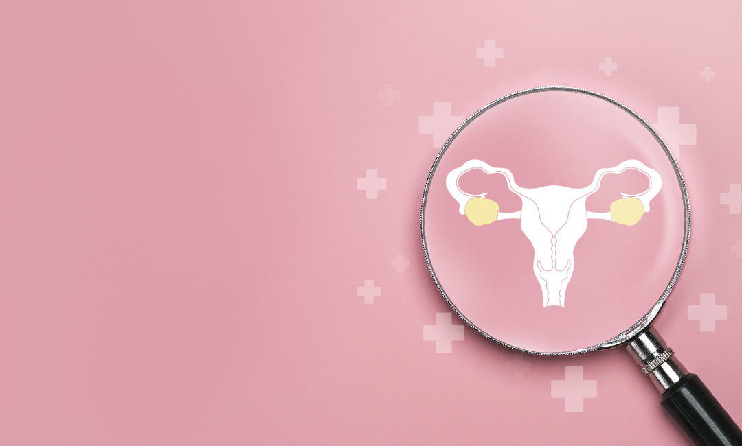 4 dicas de como diagnosticar câncer de ovário